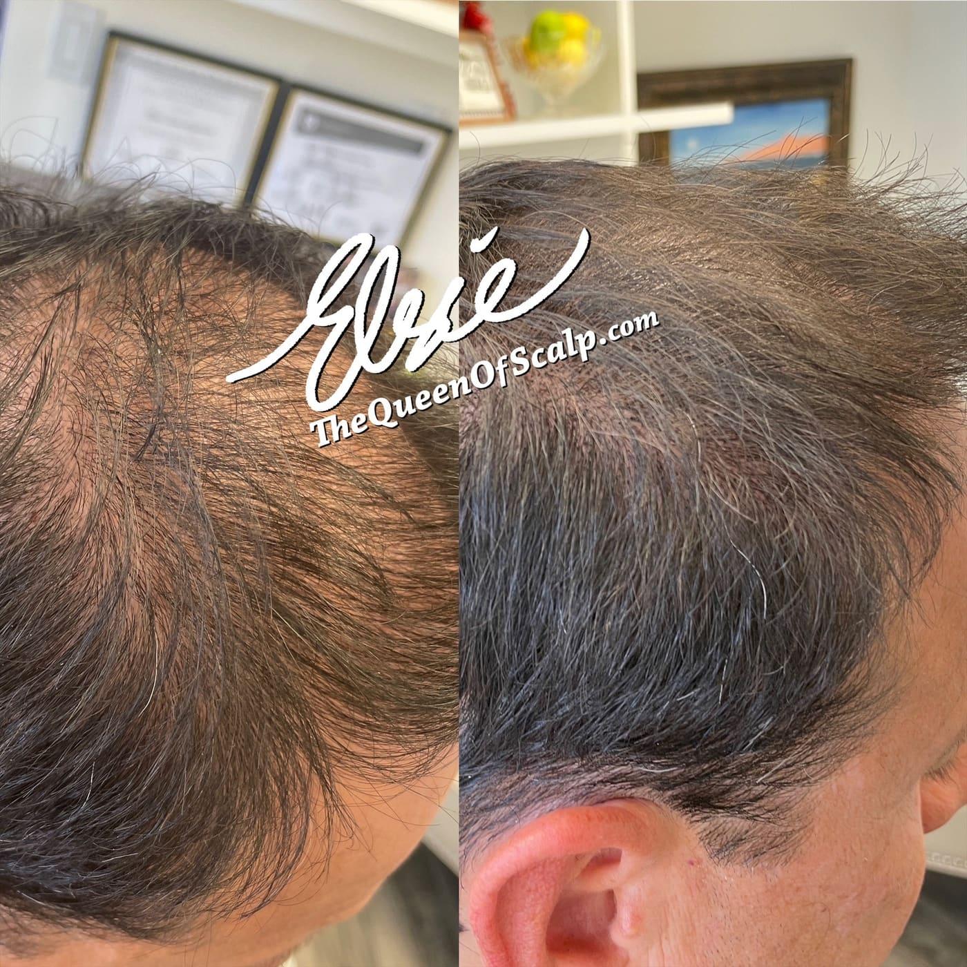 Before and after scalp micropigmentation for men improving hairline definition at SMP Hair Clinic.