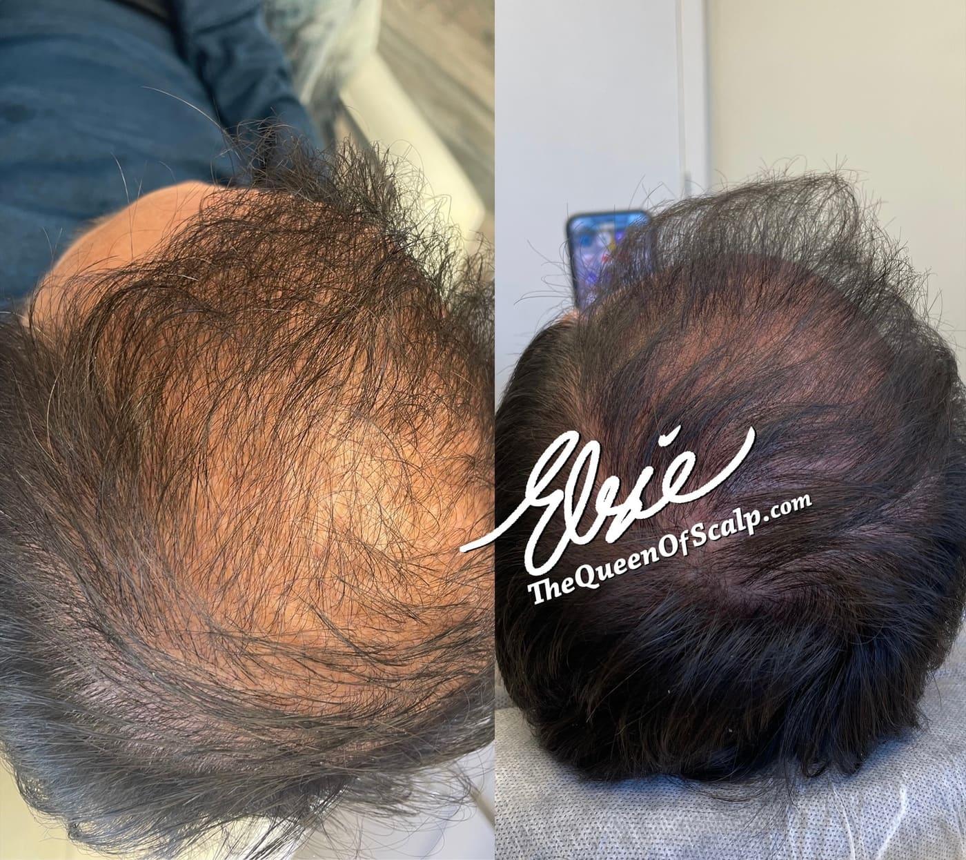 Before and after of SMP for alopecia treatment by Elsie at SMP Hair Clinic in Dallas, TX, and Orange County, CA, showing improved hair density.