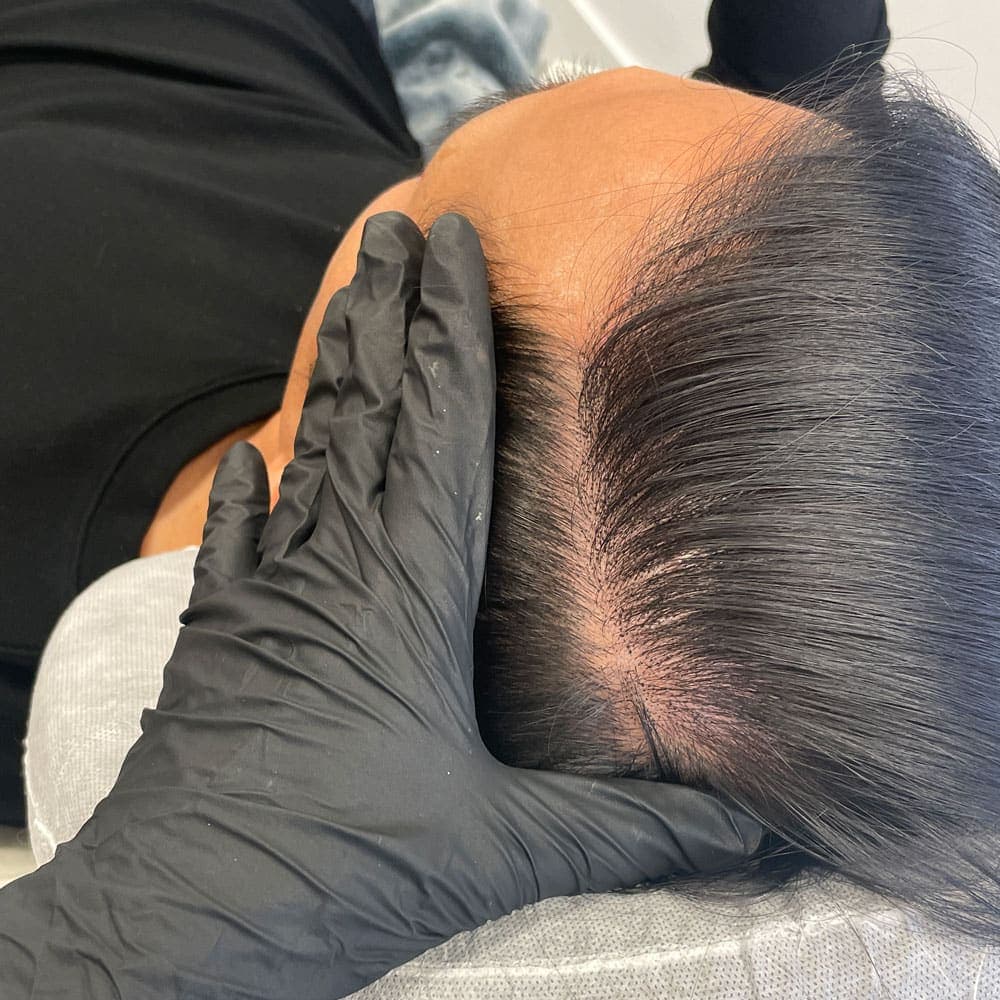 Before and after scalp micropigmentation result by Elsie