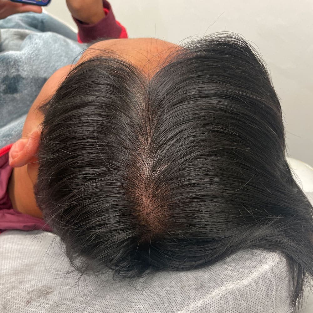 Before and after scalp micropigmentation result by Elsie