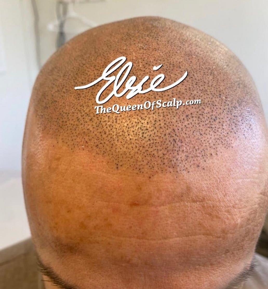 Close-up of scalp micropigmentation on a shaved head