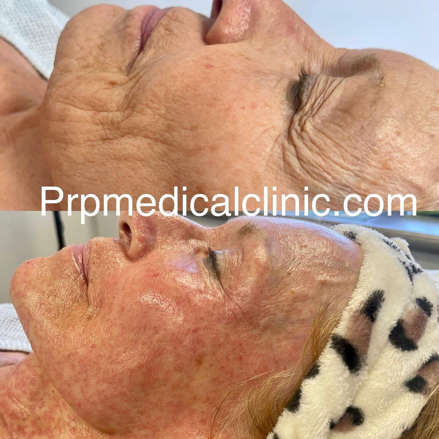 Before and after PRP skin treatment with Elsie