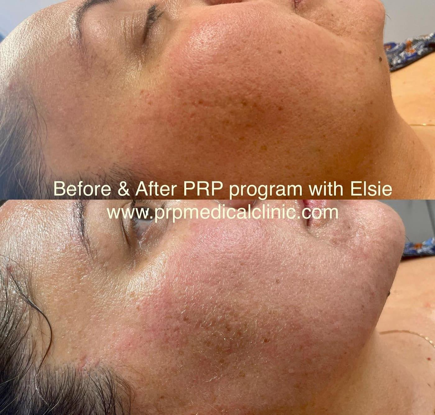Before and after PRP skin treatment with Elsie