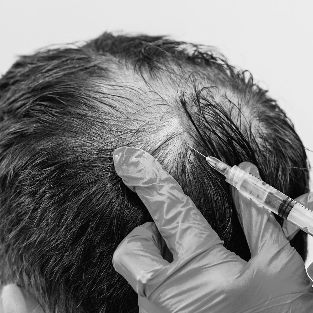 PRP injection treatment for the scalp