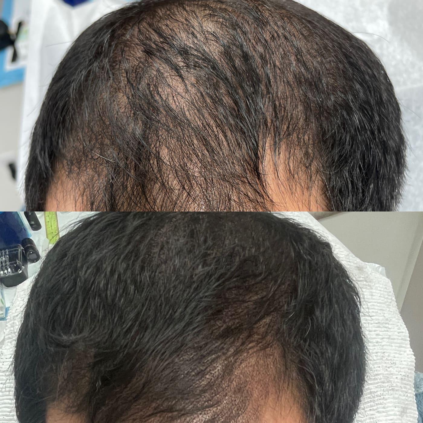Before and after scalp micropigmentation result by Elsie