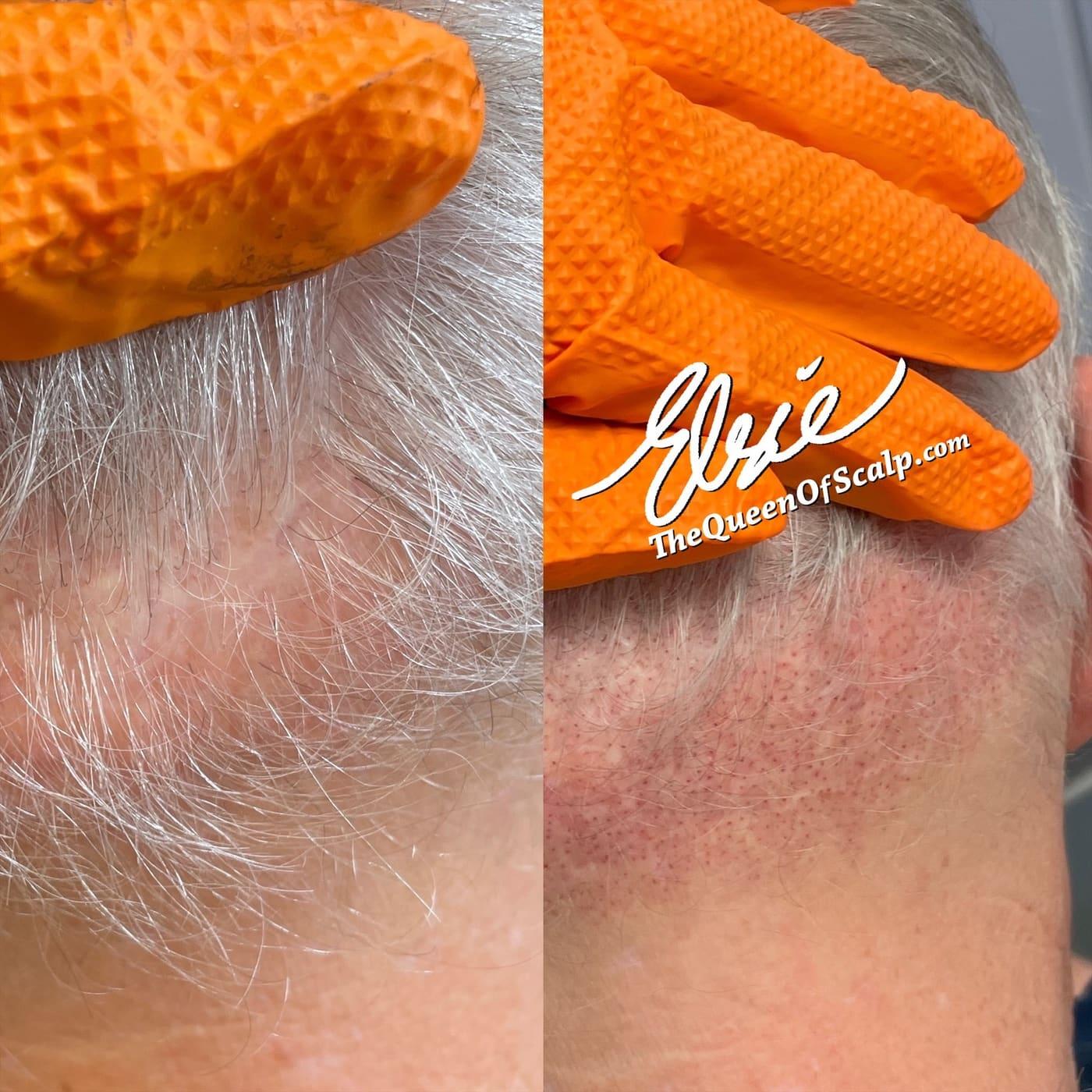 SMP Scar treatment for scalp scarring, blending pigmentation to conceal and camouflage visible scars for a smooth, natural appearance.