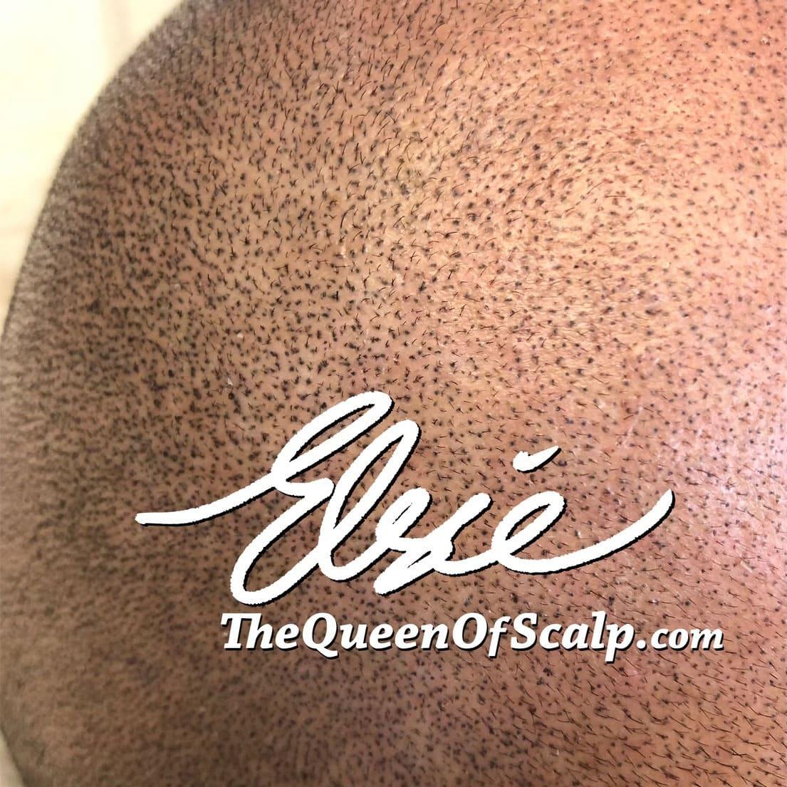 Close-up of scalp micropigmentation dots on a healed scalp