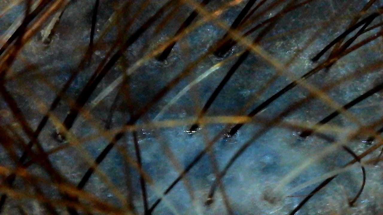 Trichoscopy close-up of hair and scalp