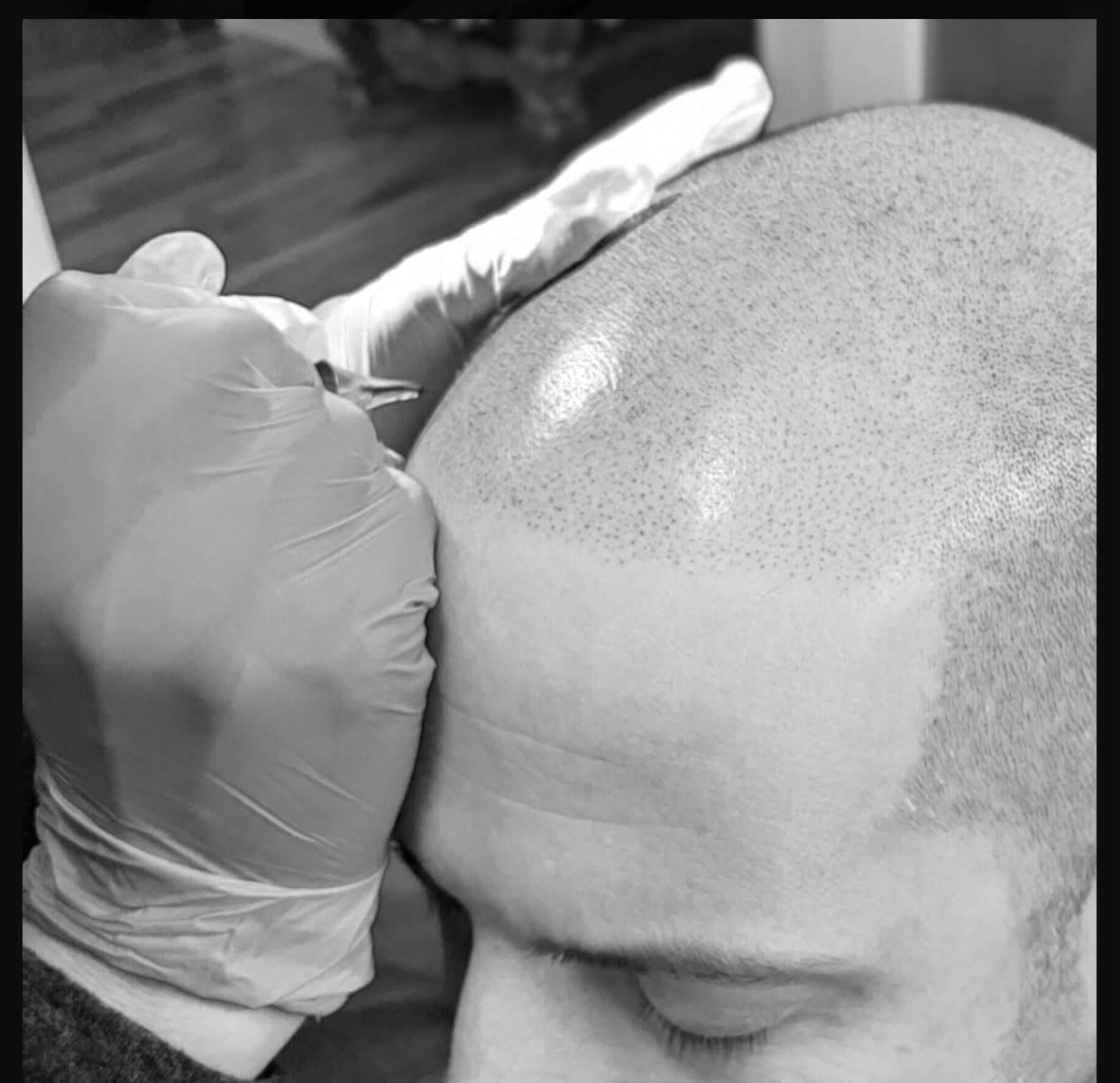 Elsie performing scalp micropigmentation on a client