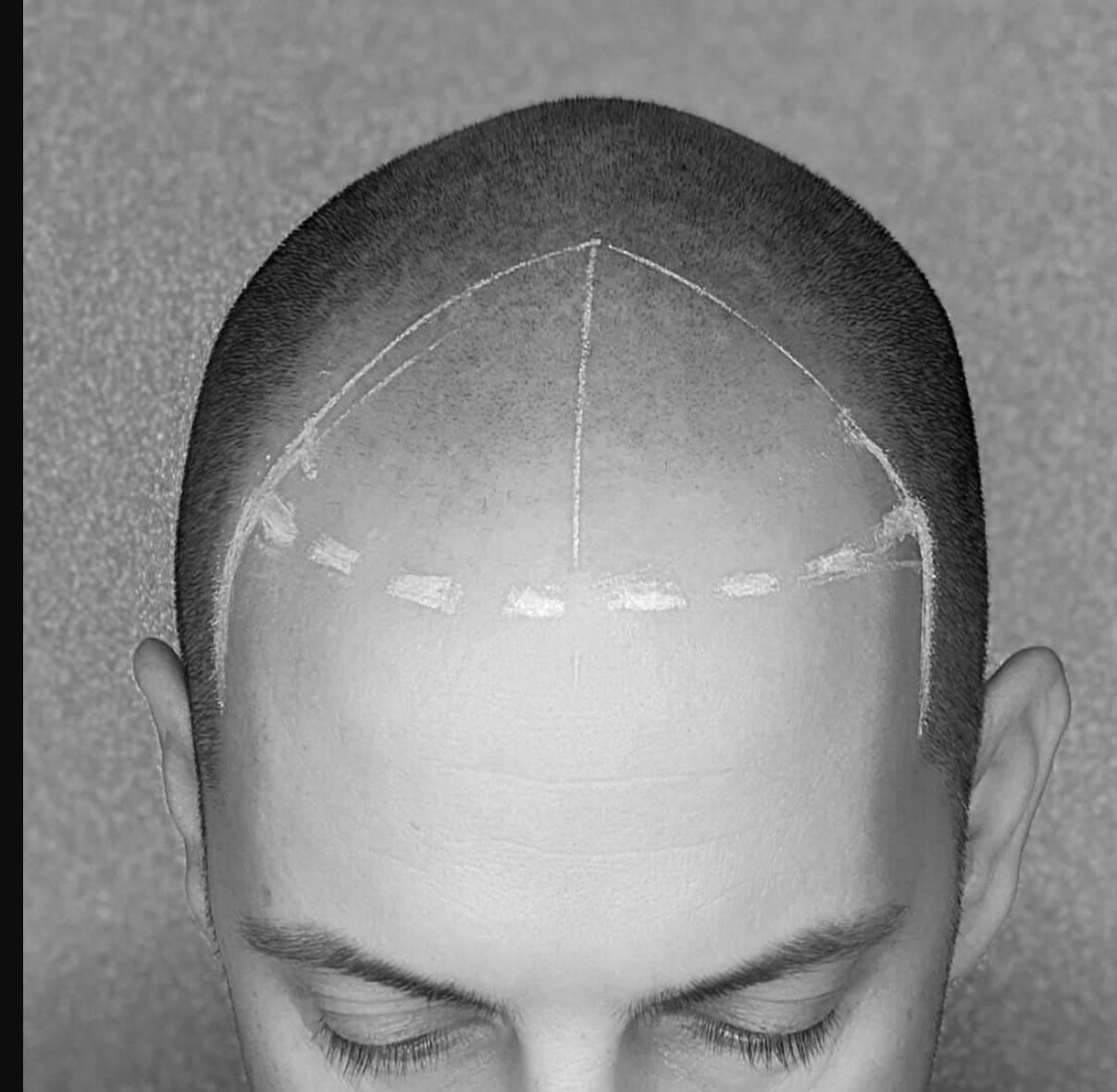 Hairline design marked on a client before scalp micropigmentation