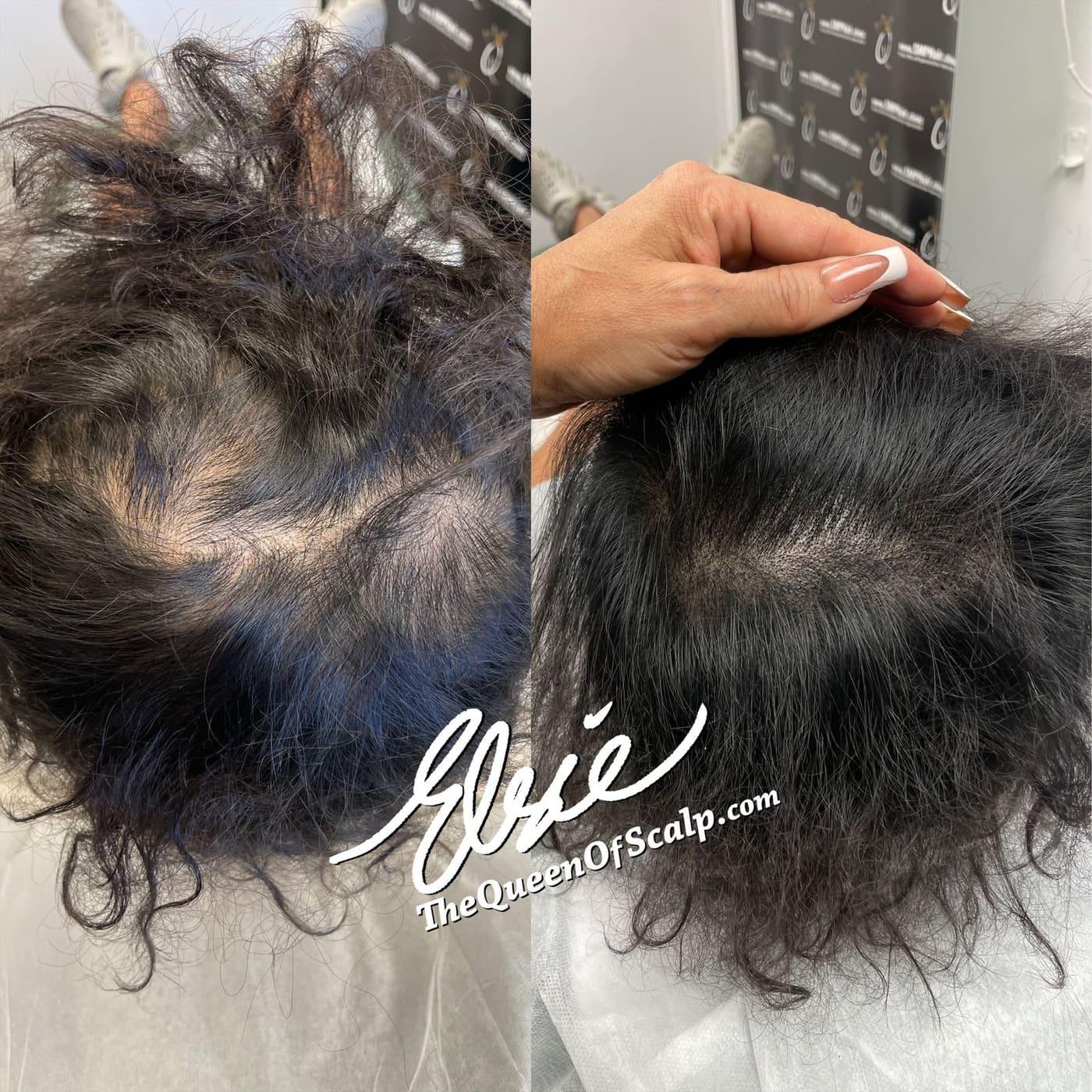 Before and after scalp micropigmentation result by Elsie