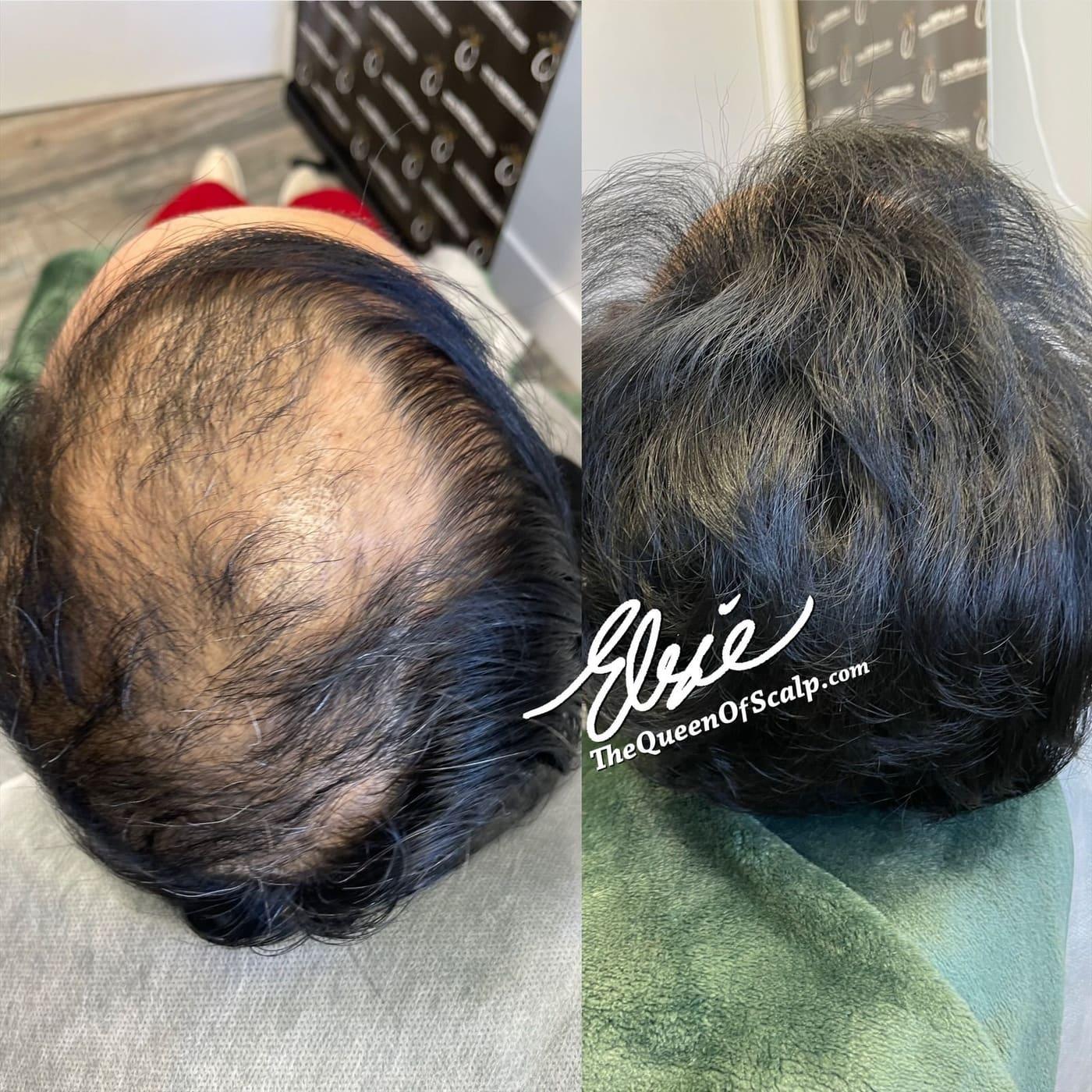 Before and after scalp micropigmentation result by Elsie