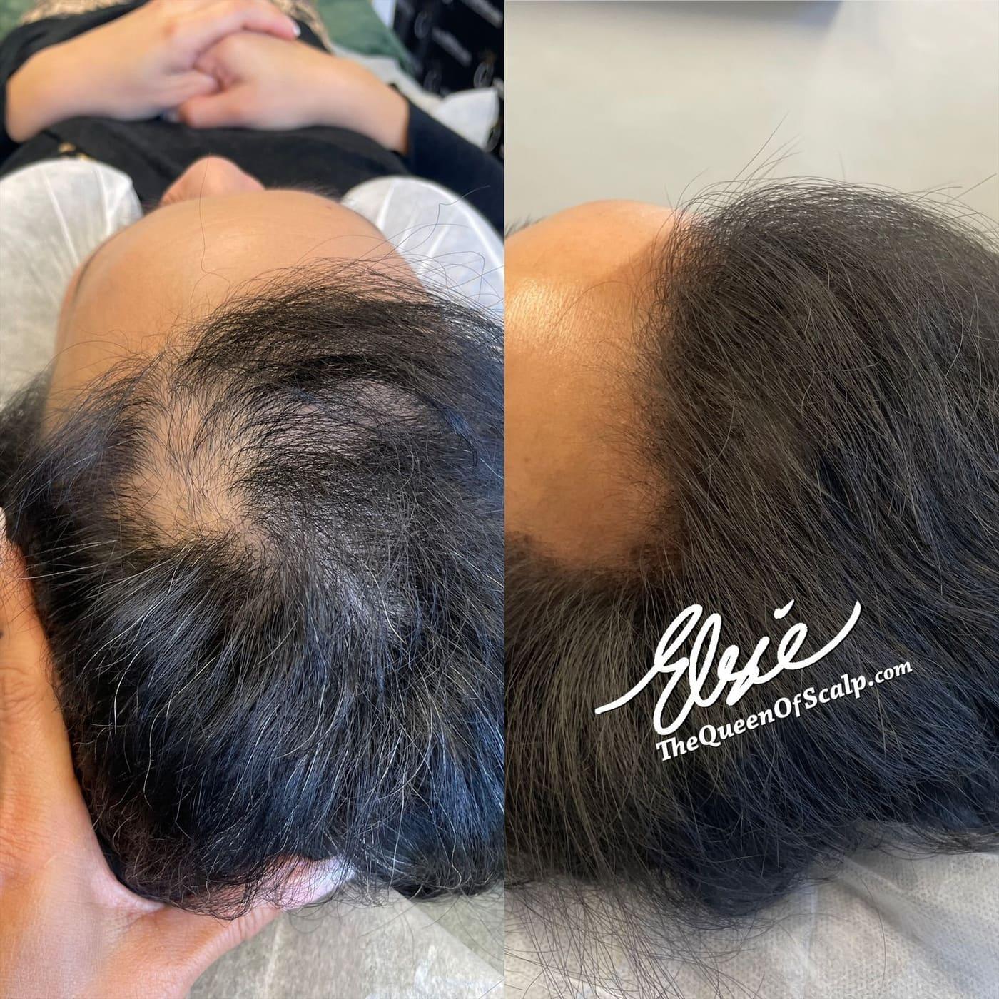 Before and after scalp micropigmentation result by Elsie