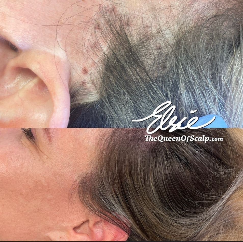 Before and after scalp micropigmentation result by Elsie