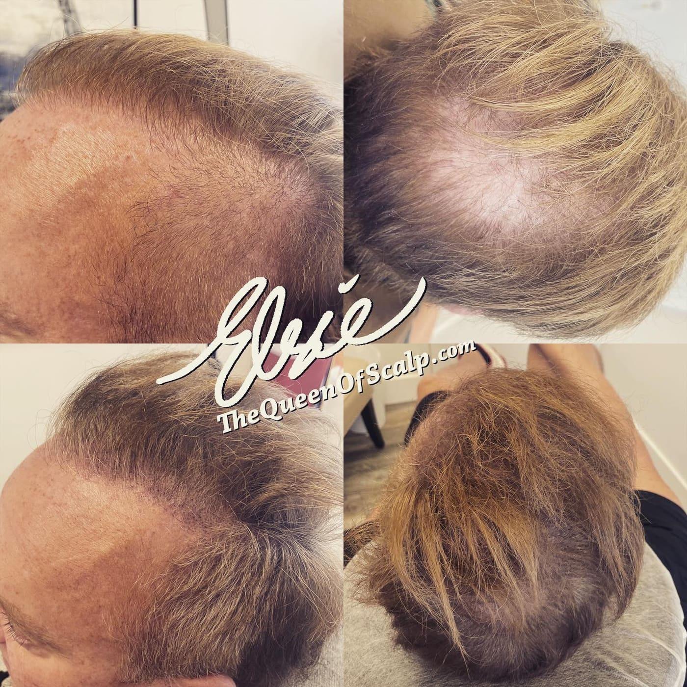 Scalp Micropigmentation procedure creating the appearance of fuller hair through detailed pigment application.