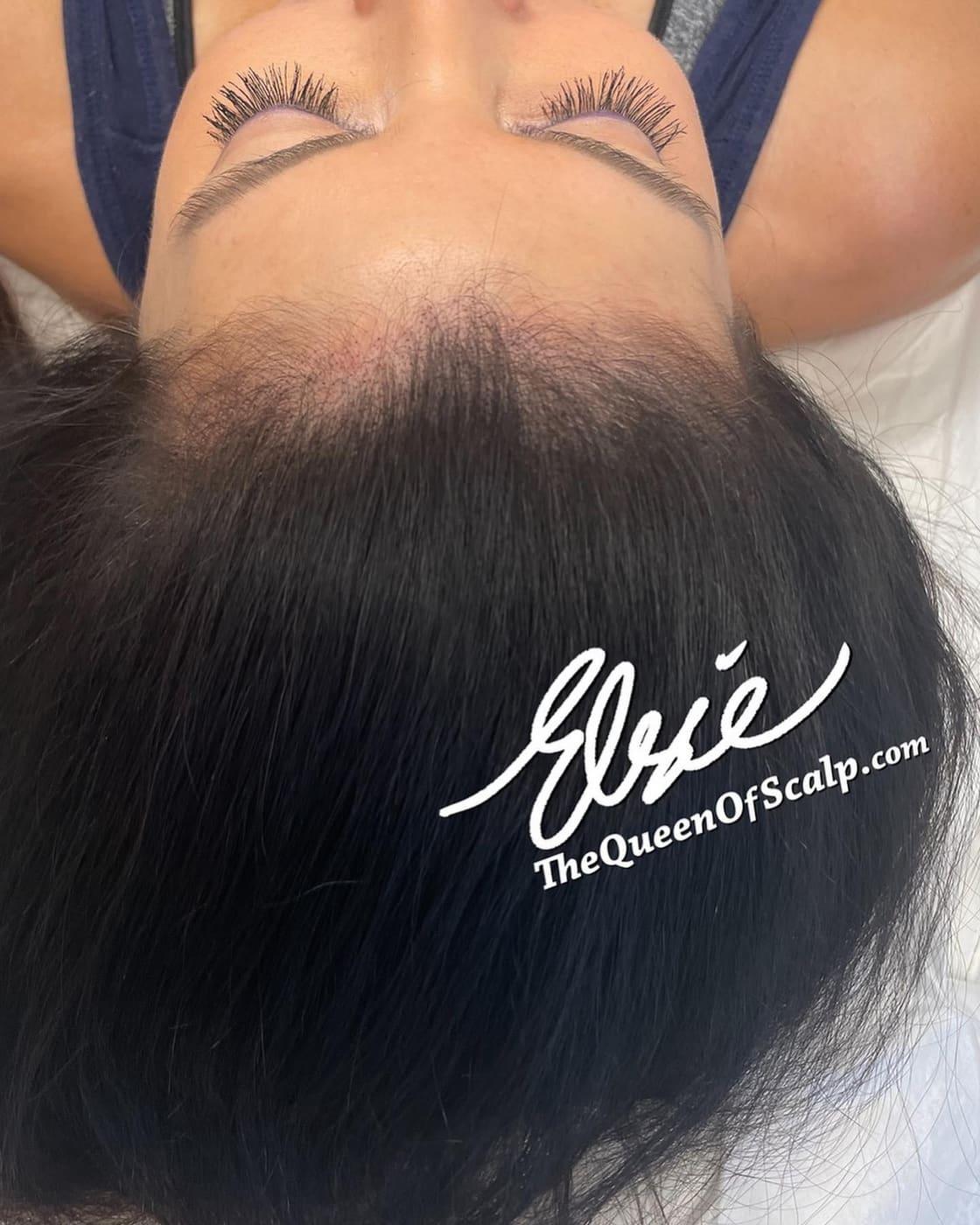 Before and after SMP treatment for women creating a fuller, natural-looking result.