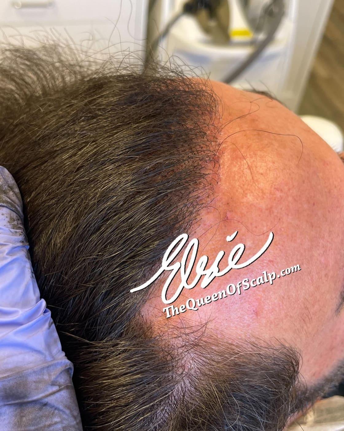 Before and after SMP showing improved hairline balance.