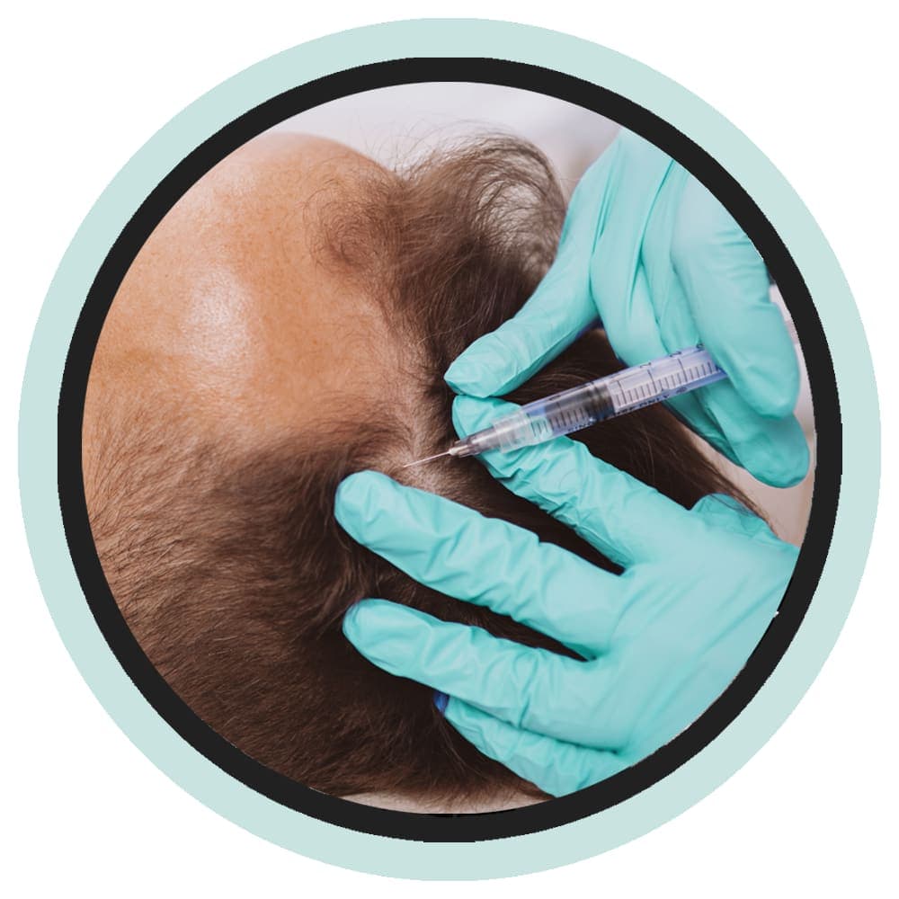 PRP injection treatment for the scalp
