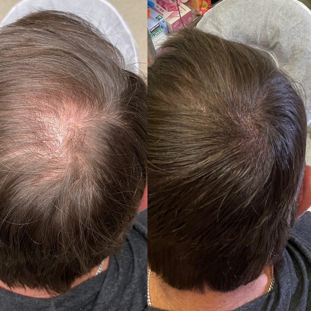 Before and after scalp micropigmentation with even, natural coverage.