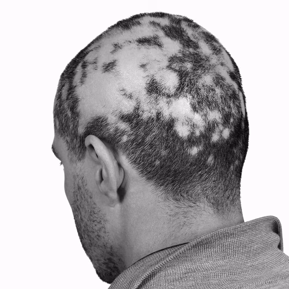 Man with patchy alopecia on the back of the scalp
