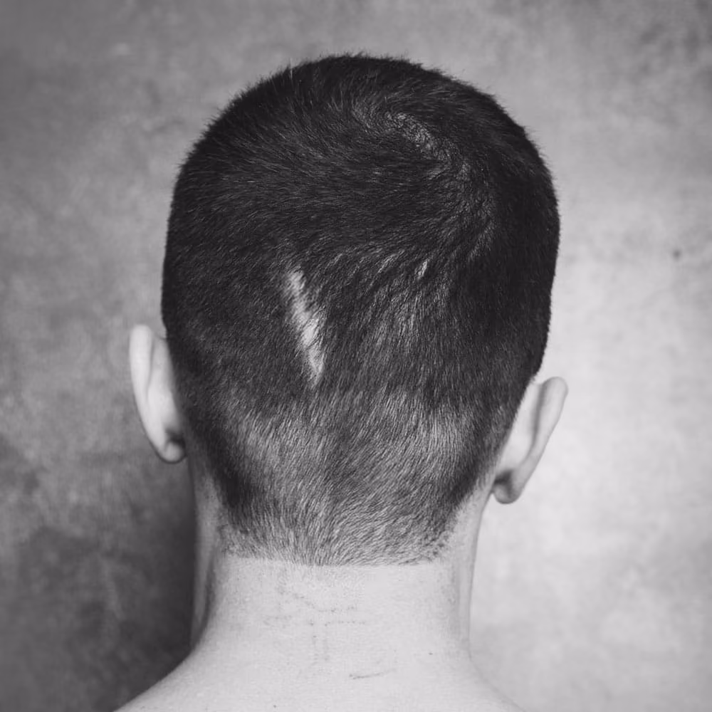 Scar on the back of a man's head