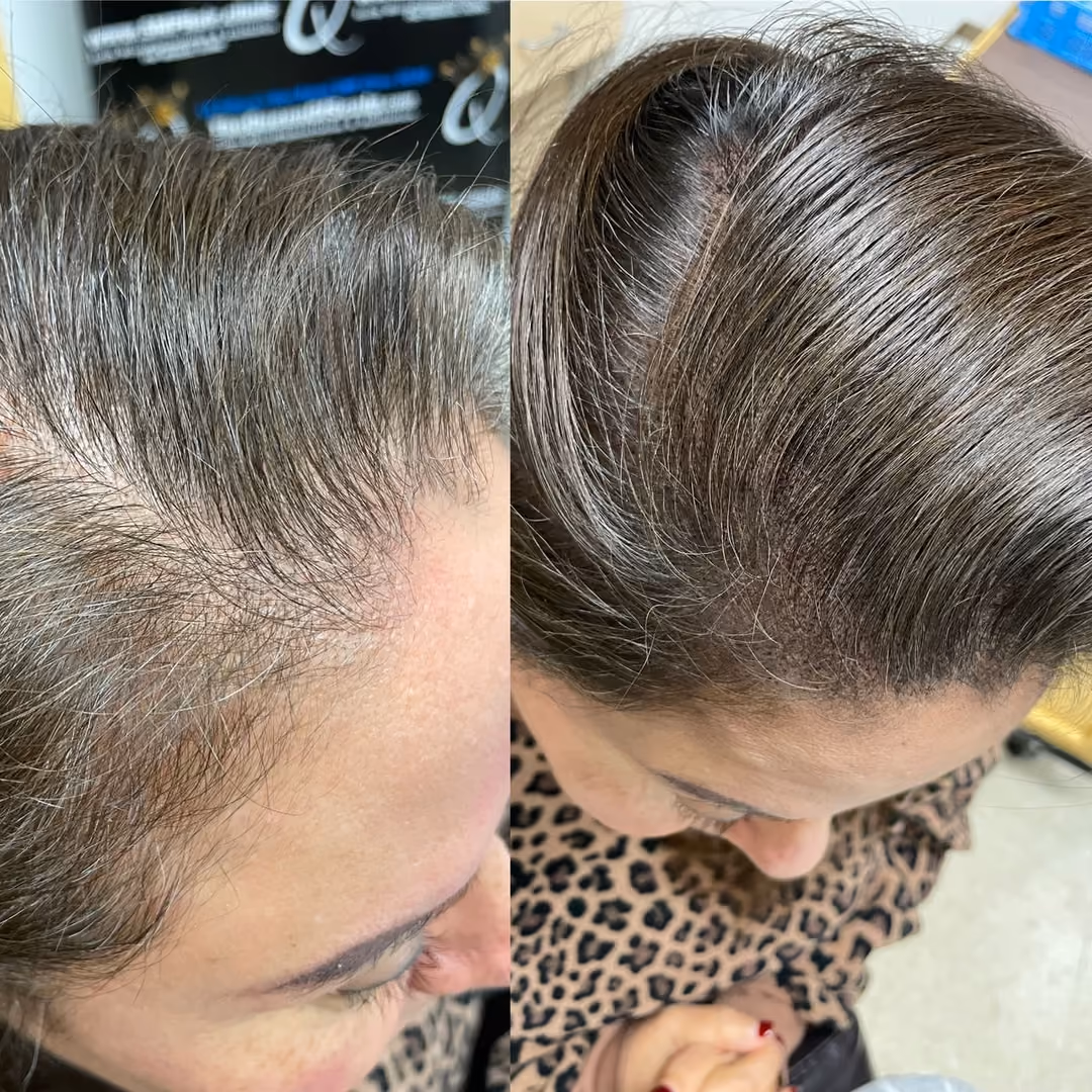 Scalp micropigmentation Newport for women, enhancing hair density and creating a fuller, natural look to conceal thinning areas.