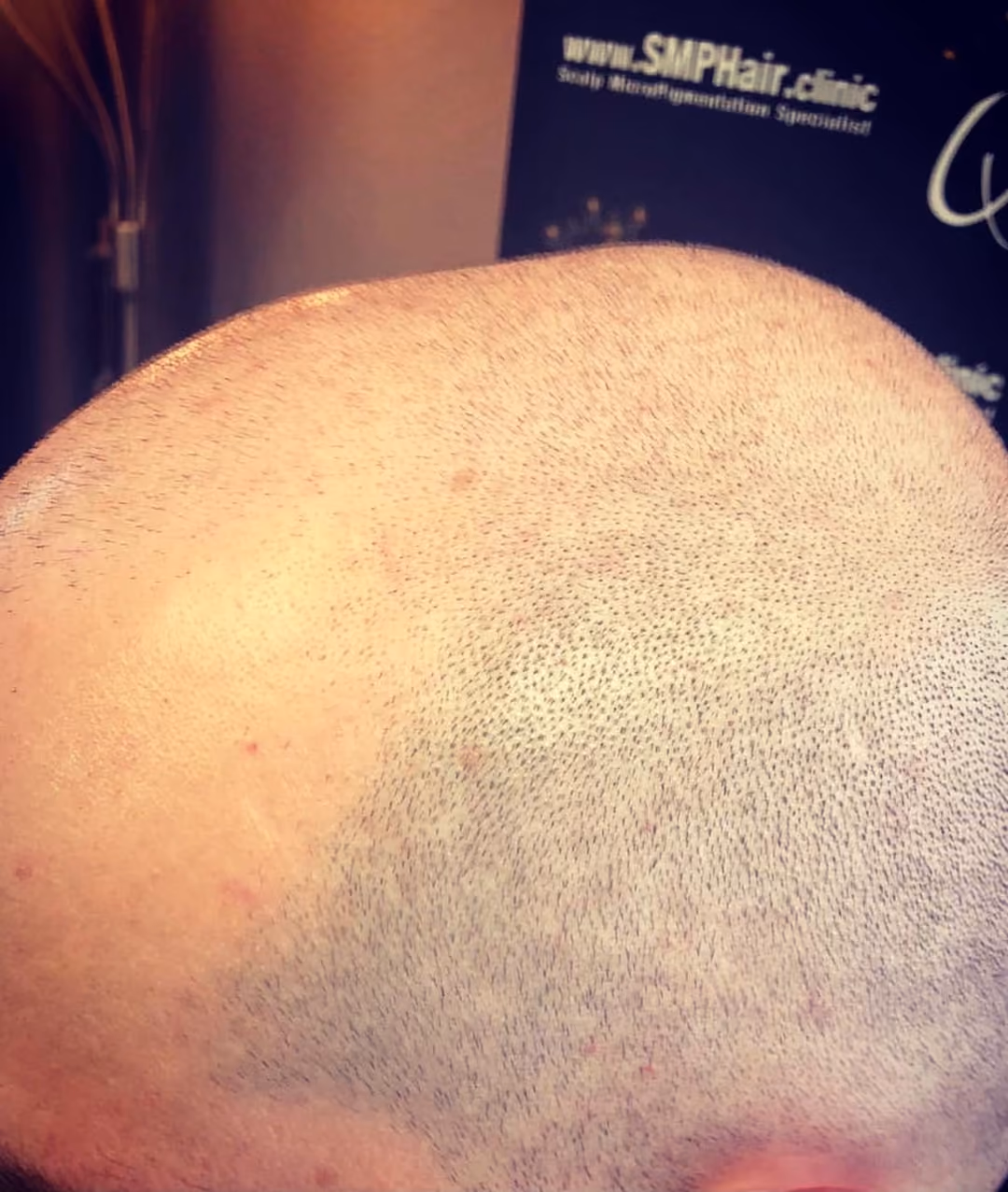 Natural looking scalp micropigmentation result