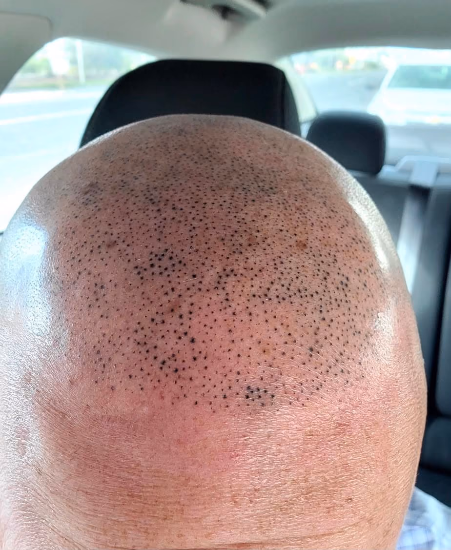 Scalp micropigmentation healing, seven days after treatment