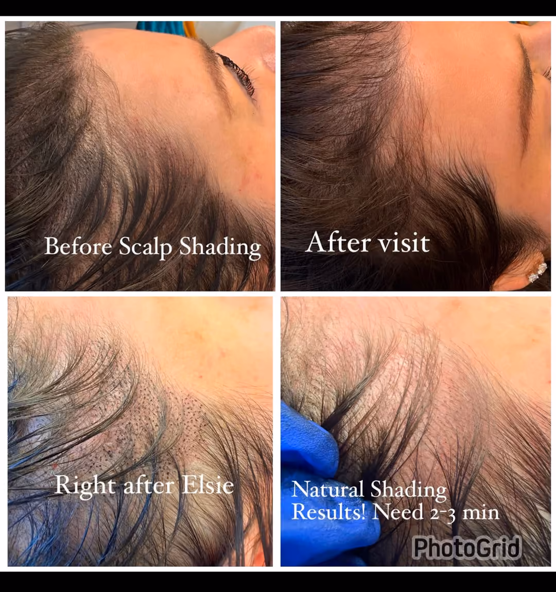 Before and after scalp micropigmentation result by Elsie