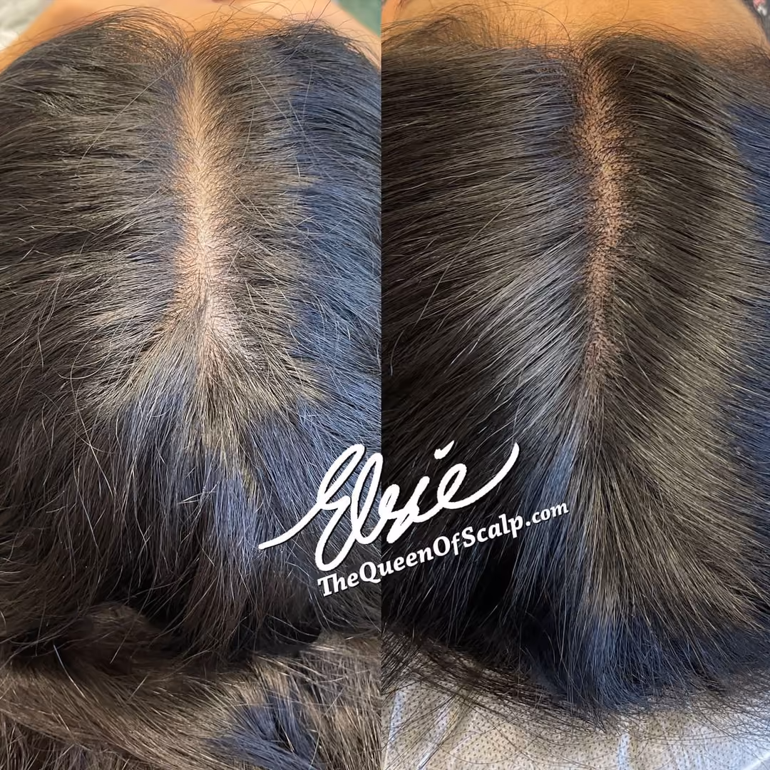 Before and after scalp micropigmentation result by Elsie