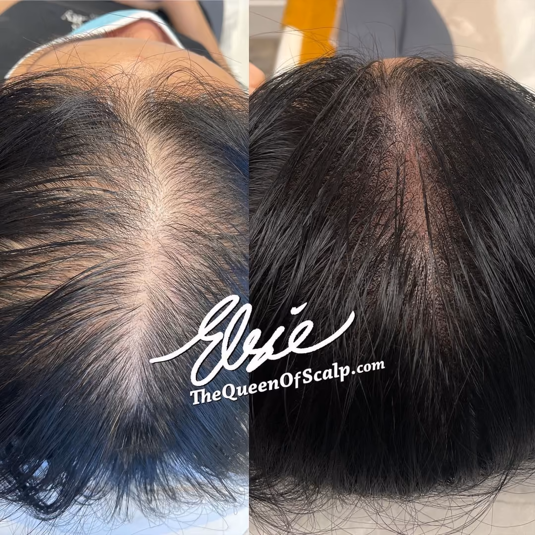 Before and after scalp micropigmentation for women improving hair density and concealing thinning areas.